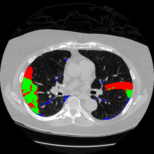 Radiologist annotation vs method prediction, slice 141