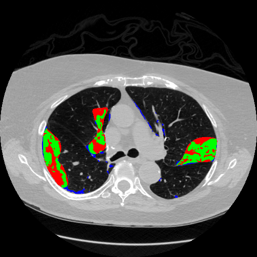 Radiologist annotation vs method prediction, slice 163