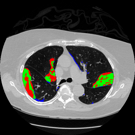 Radiologist annotation vs method prediction, slice 165
