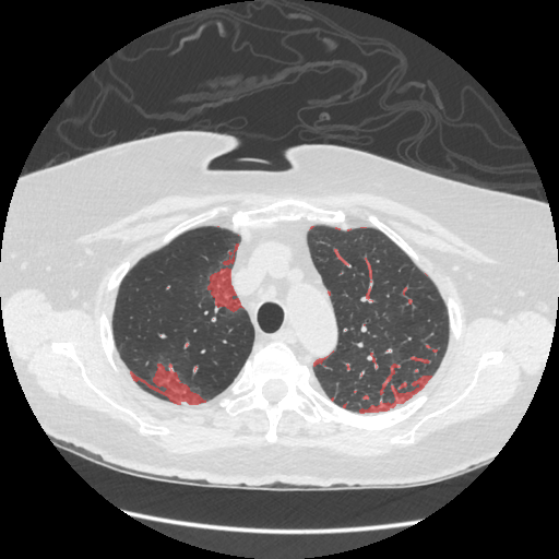 Sample 2 with infection overlay