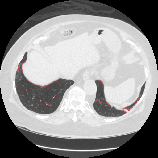 Sample 3 with infection overlay