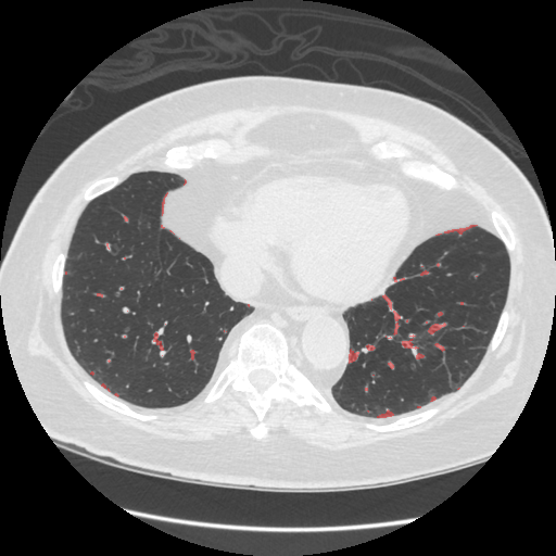 Sample 4 with infection overlay
