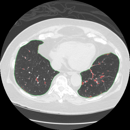 Infection overlay, slice 83