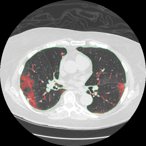 Infection overlay, slice 137