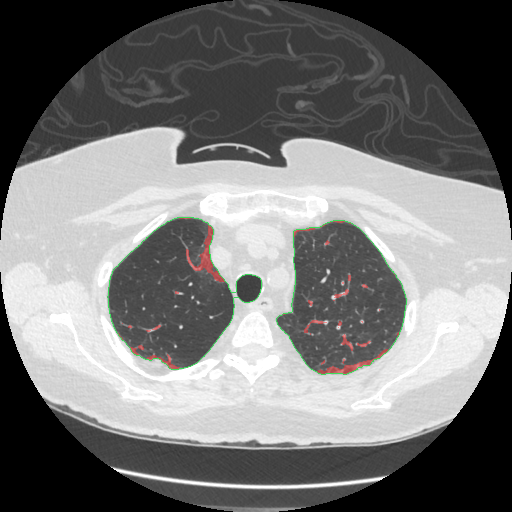 Infection overlay, slice 205