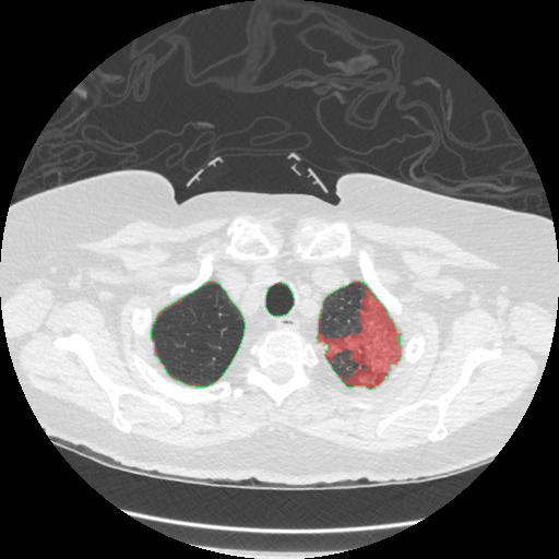 Infection overlay, slice 225